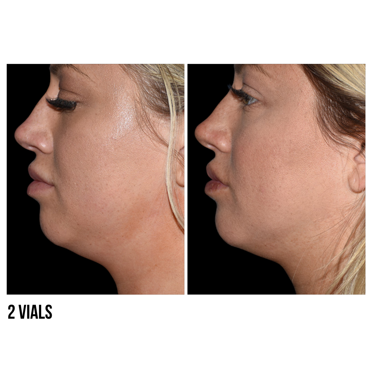 Kybella®