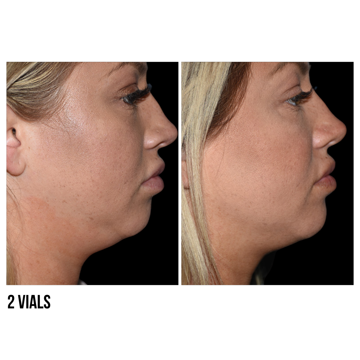 Kybella®