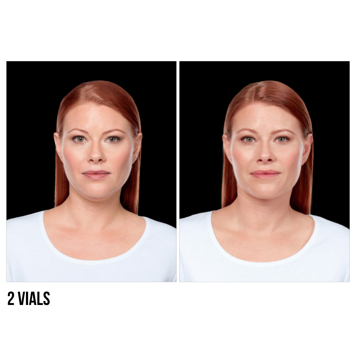 Kybella®