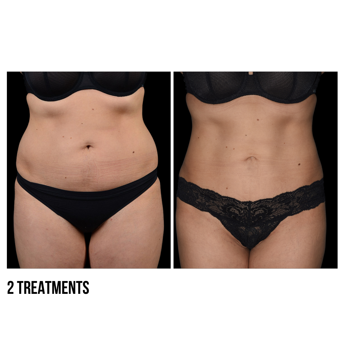 CoolSculpting®