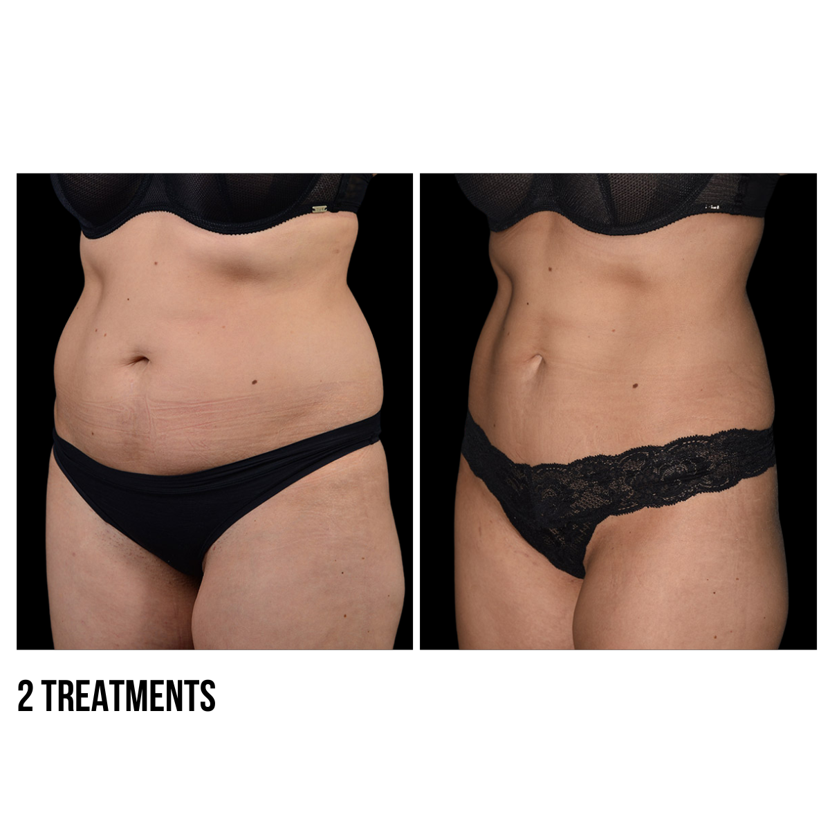 CoolSculpting®