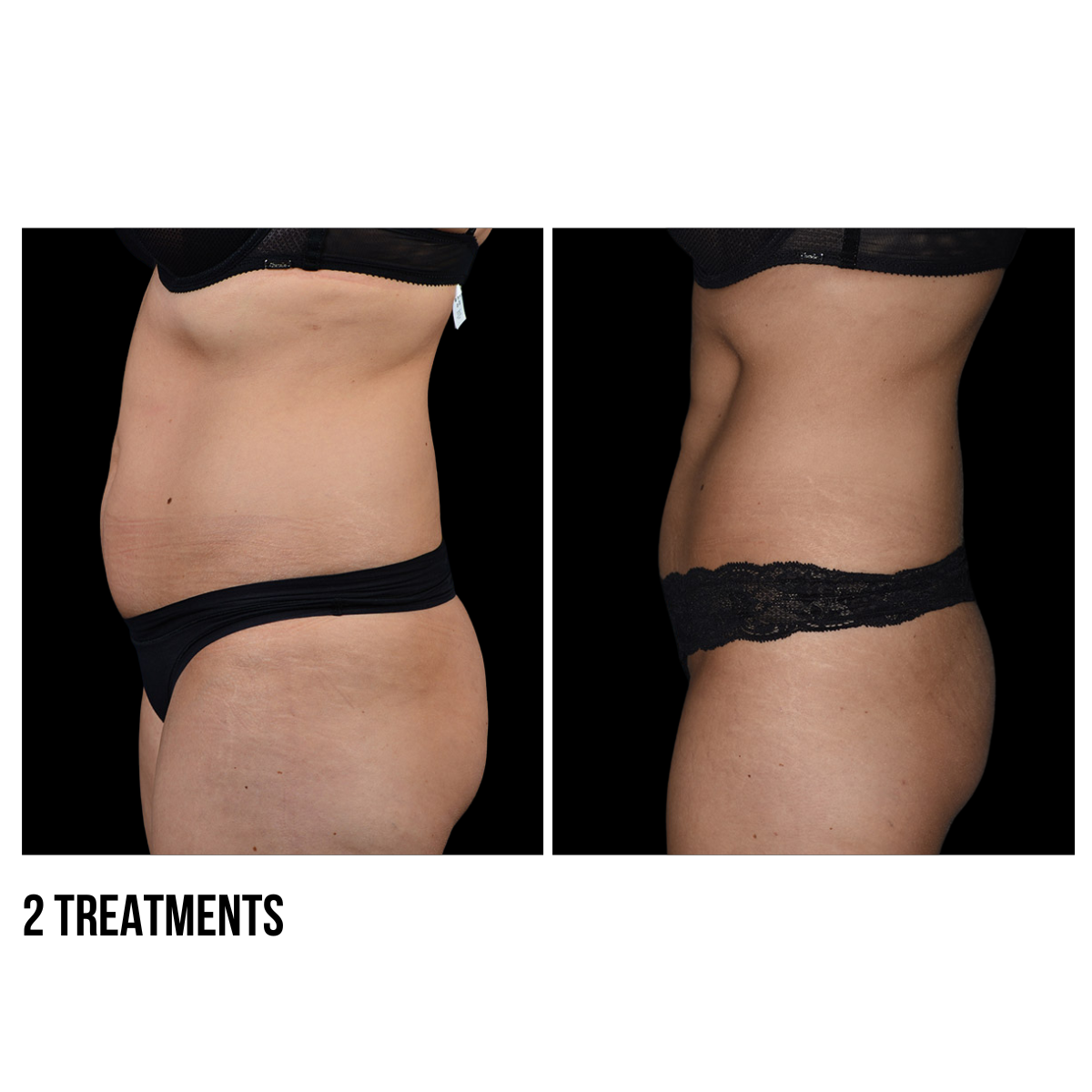 CoolSculpting®