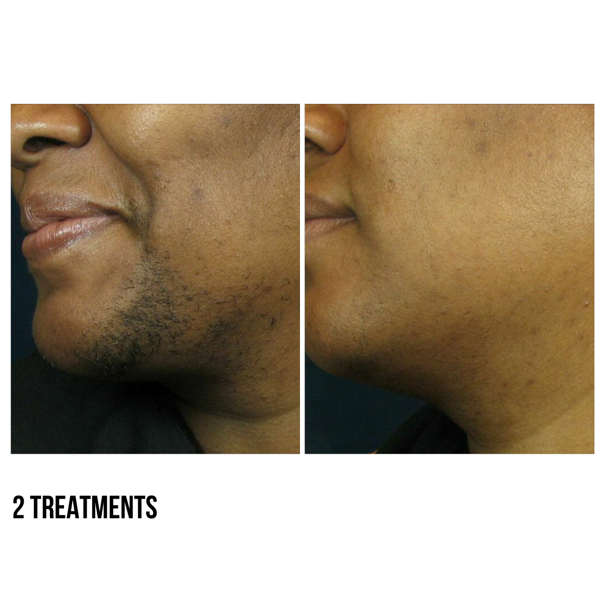 Laser Hair Removal