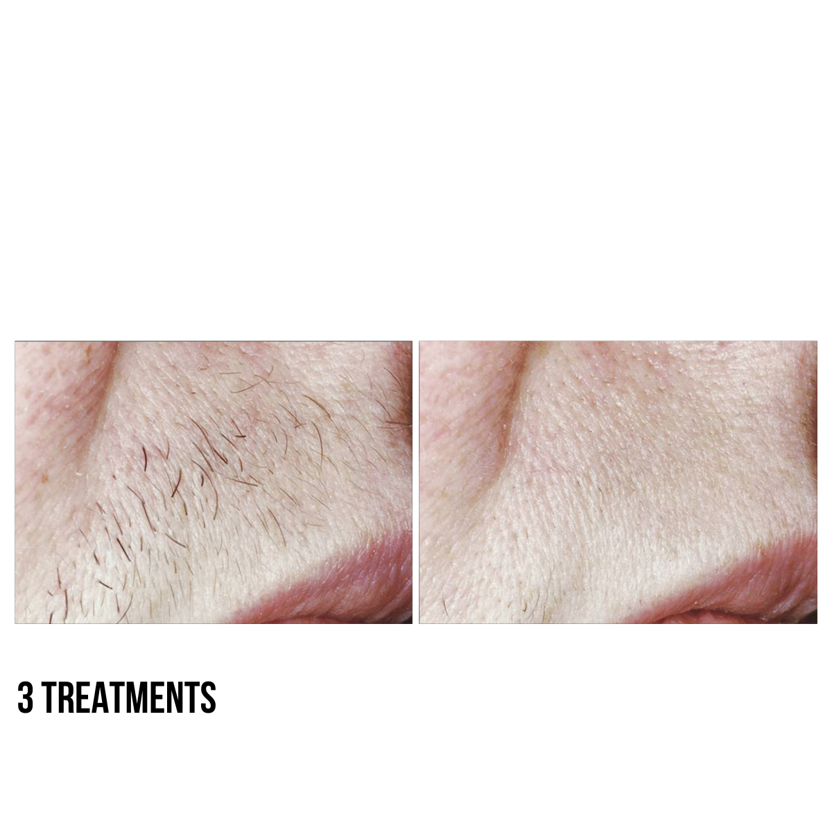 Laser Hair Removal