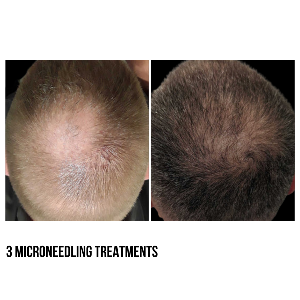 Hair Restoration