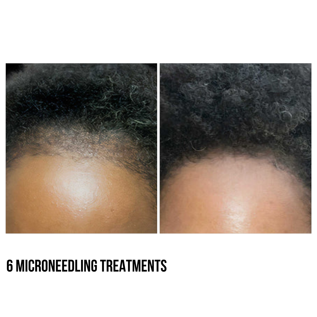 Hair Restoration
