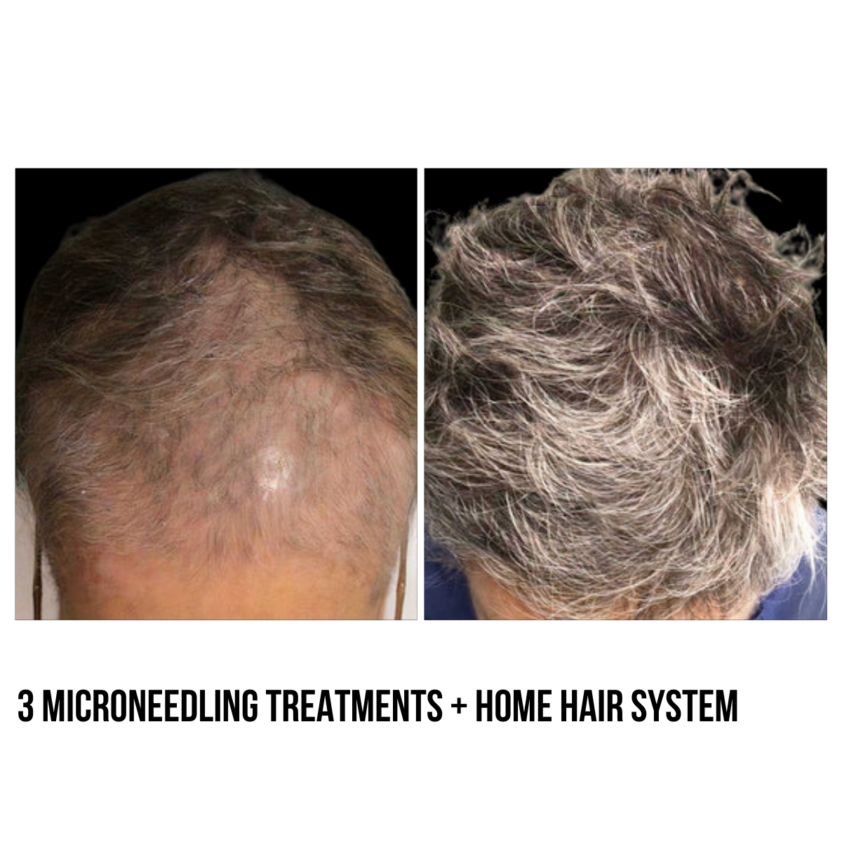 Hair Restoration