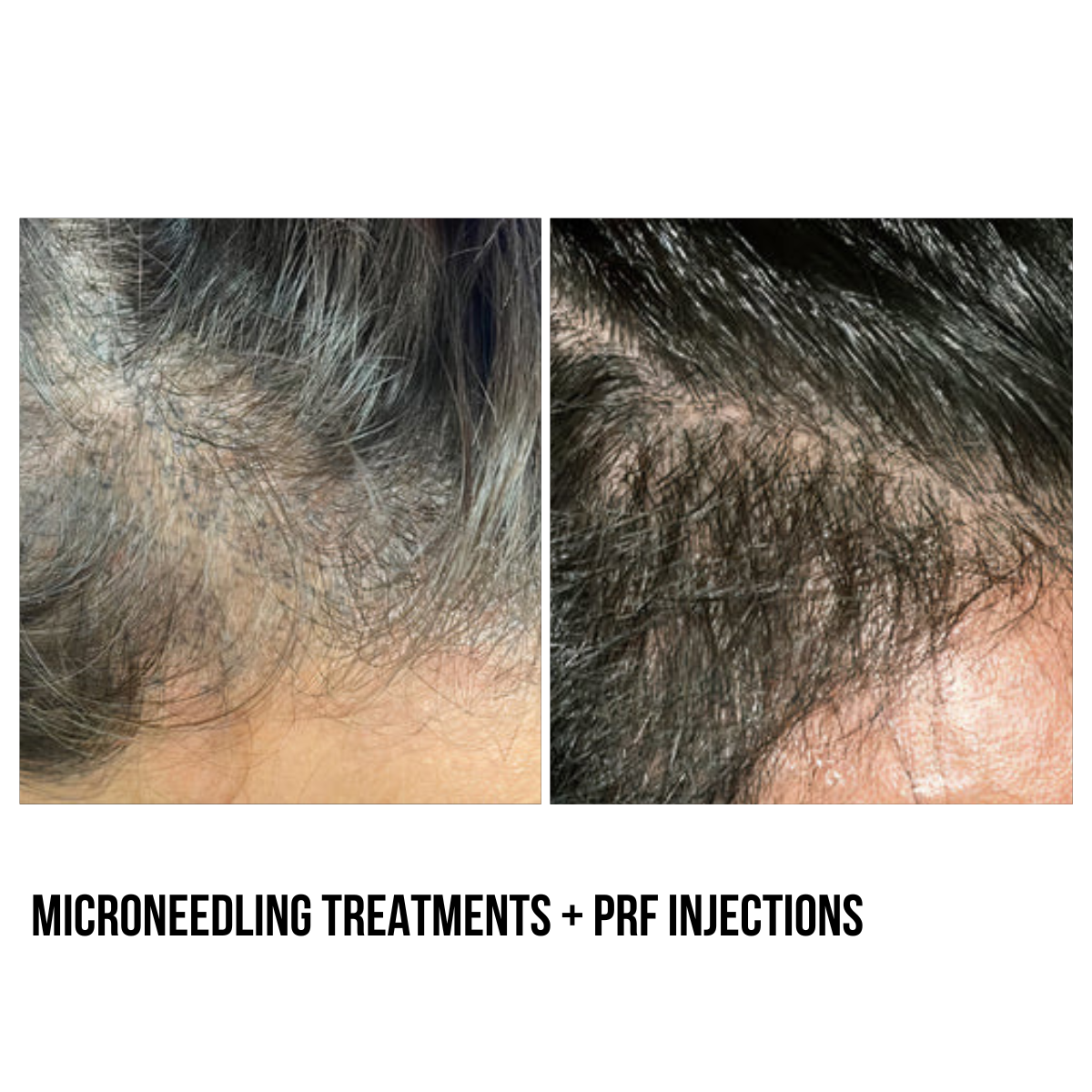 Hair Restoration