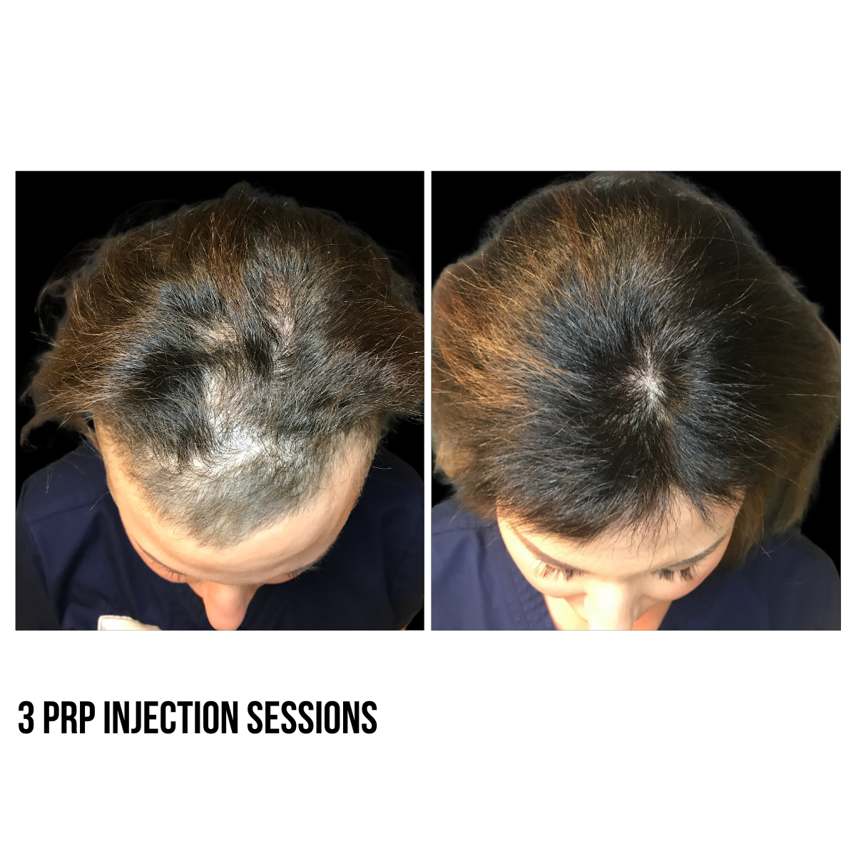 Hair Restoration