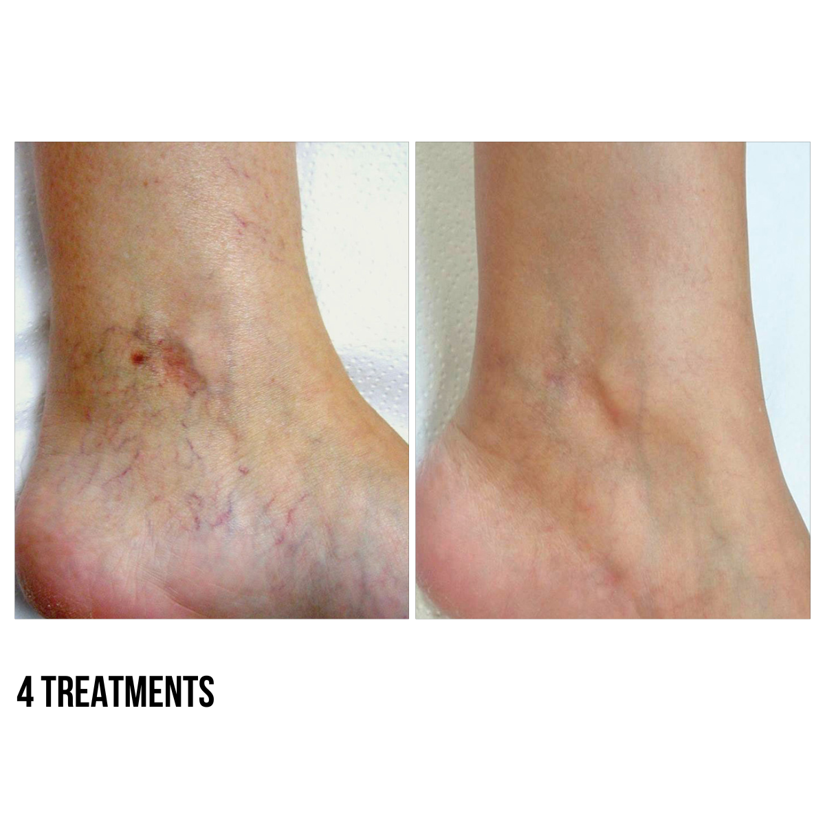 Laser Vein Therapy