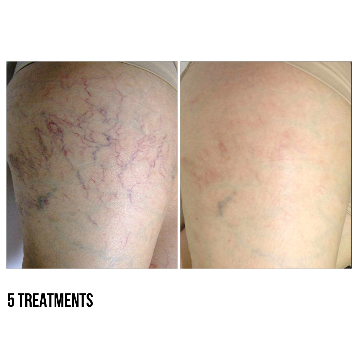 Laser Vein Therapy