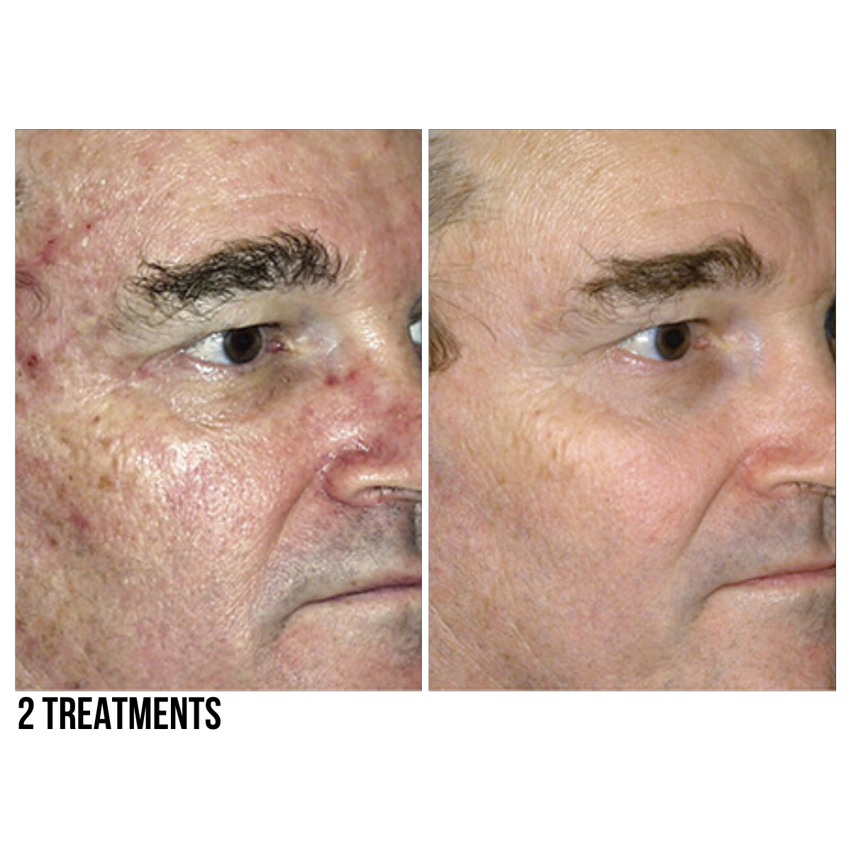 MicroLaserPeel®