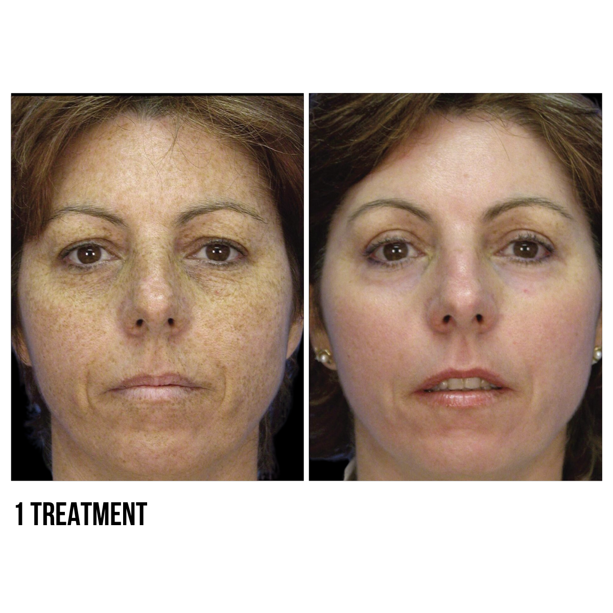MicroLaserPeel®