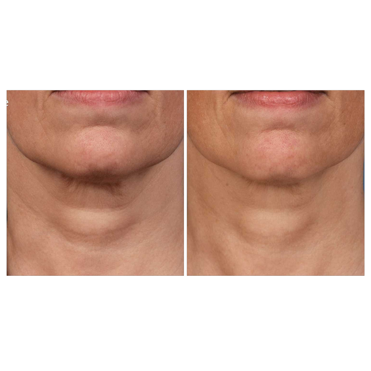 Microneedling