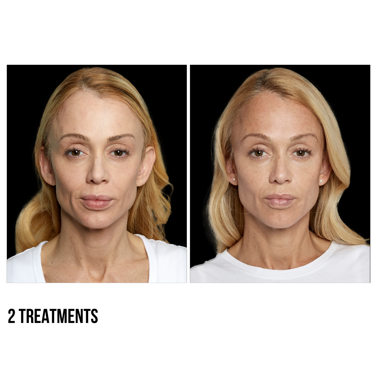 Sculptra®