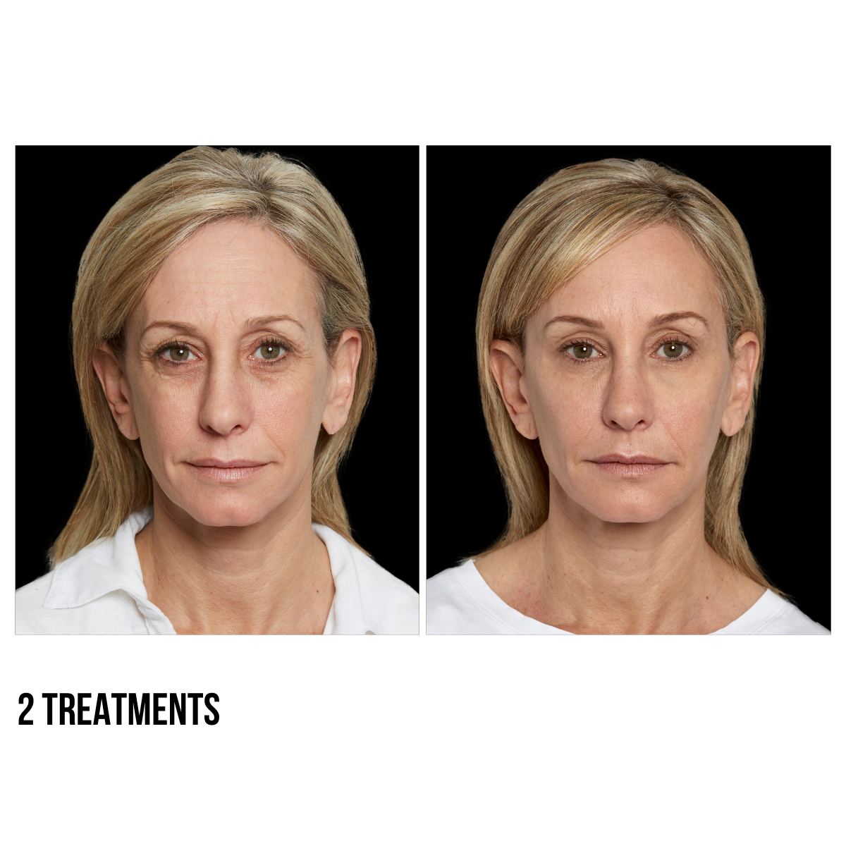 Sculptra®