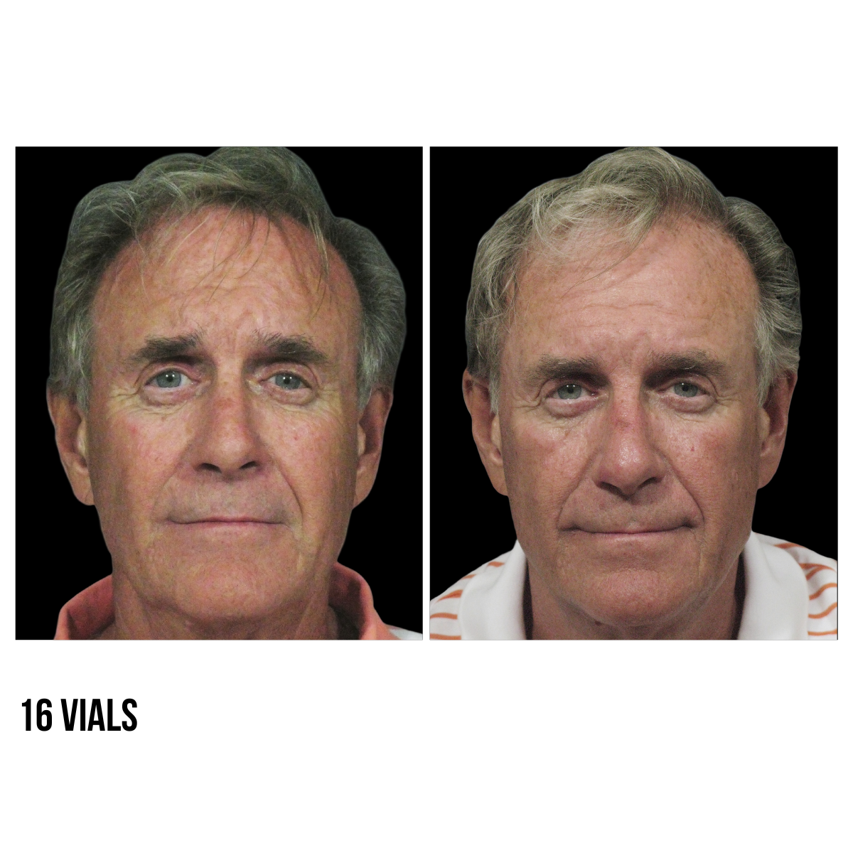 Sculptra®