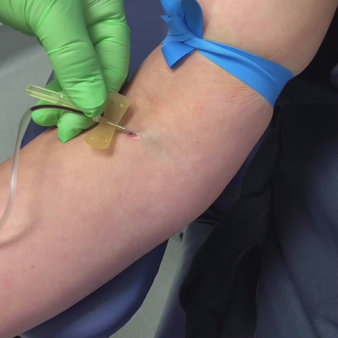 woman getting Hair restoration for alopecia with prp platelet rich plasma injections