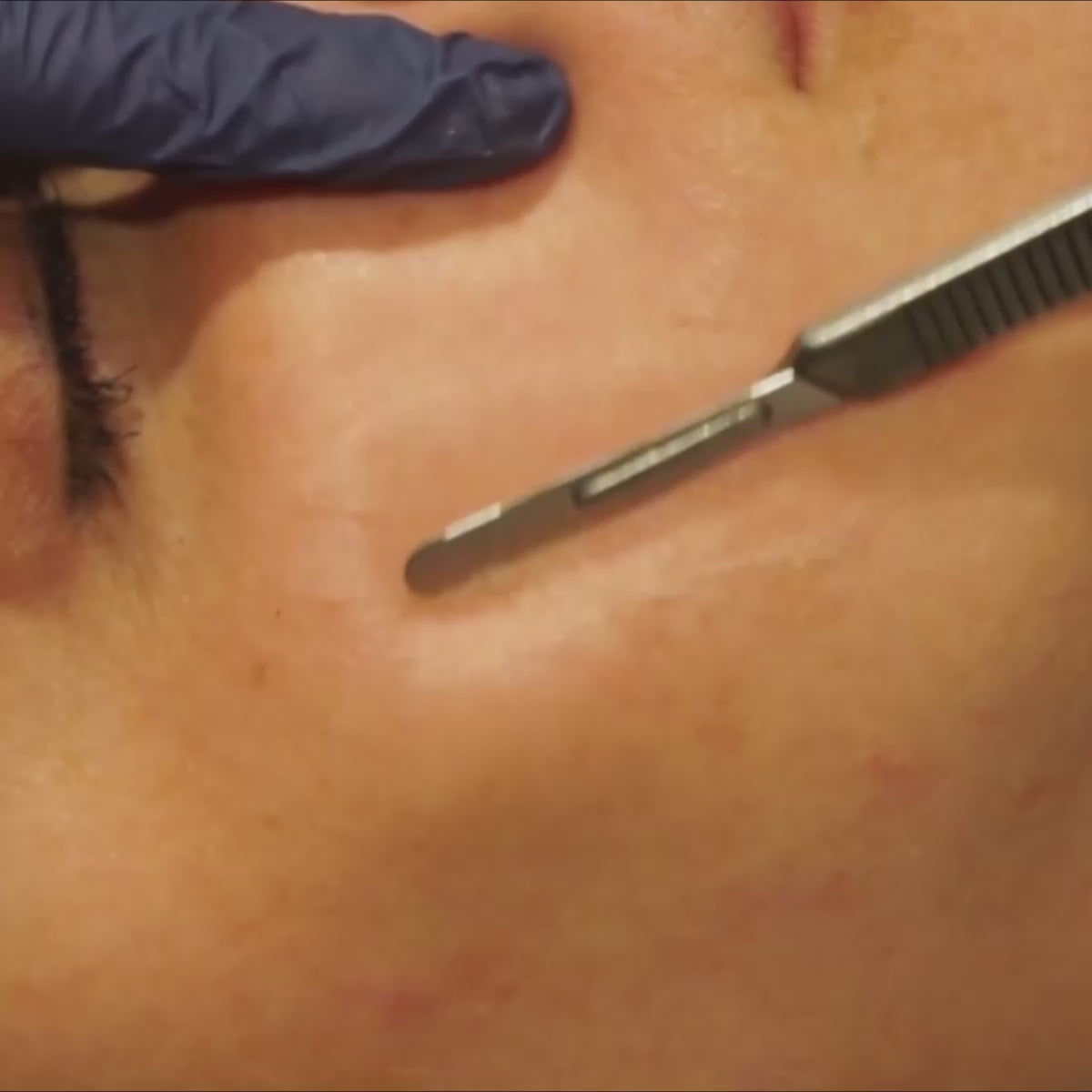 Woman getting manual exfoliation with Dermaplaning of the skin