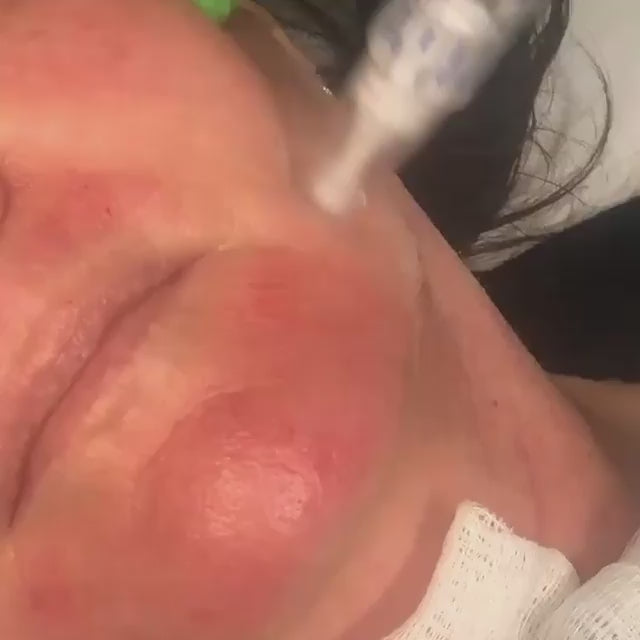 woman getting microneedling with growth factor for wrinkles
