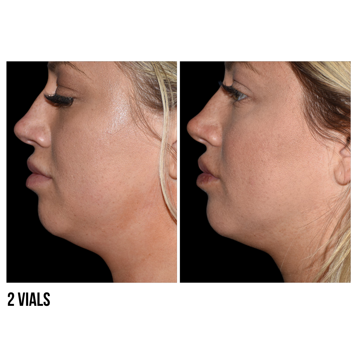 Kybella® – Non-Surgical Double Chin Reduction