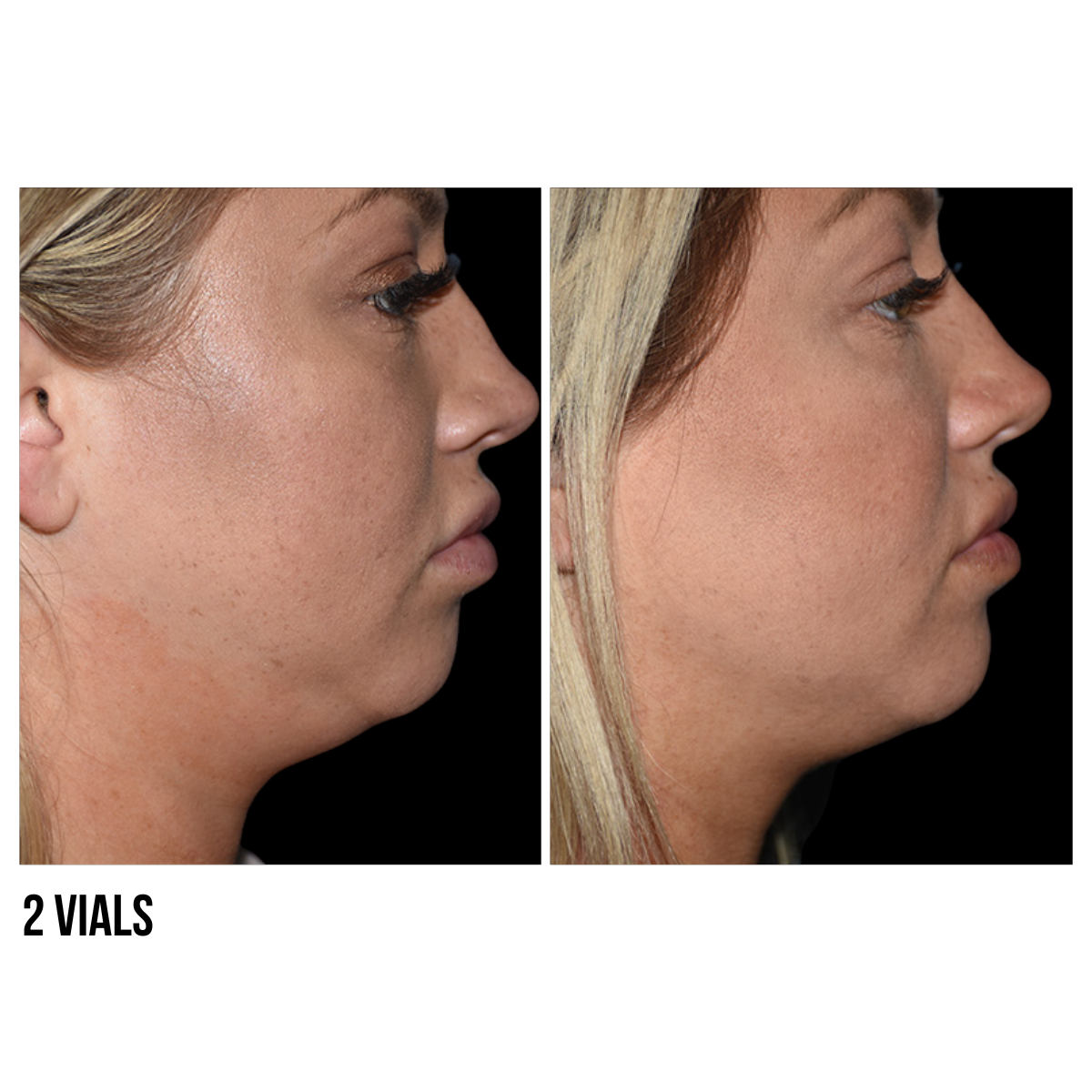 Kybella® – Non-Surgical Double Chin Reduction