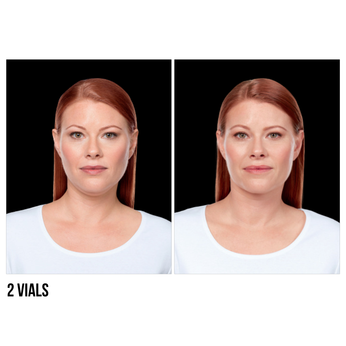 Kybella® – Non-Surgical Double Chin Reduction