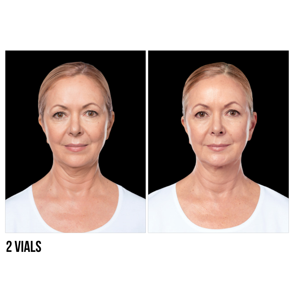 Kybella® – Non-Surgical Double Chin Reduction