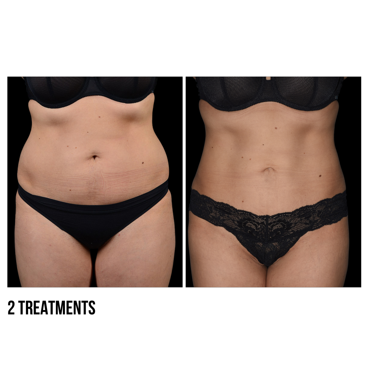 CoolSculpting® Body Contouring – Non-Invasive Fat Reduction