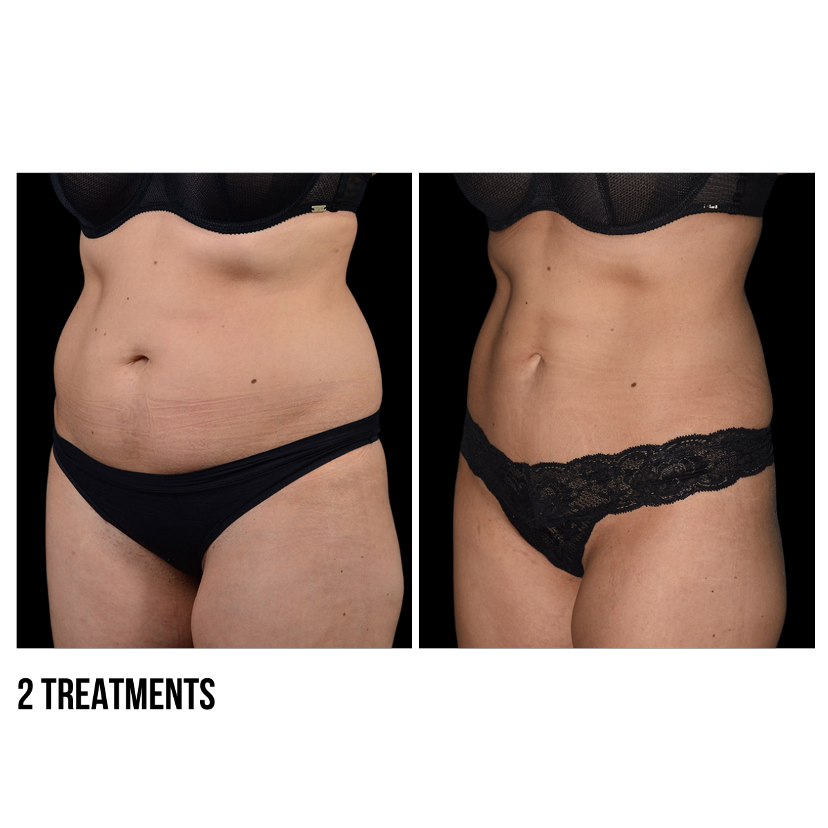 CoolSculpting® Body Contouring – Non-Invasive Fat Reduction