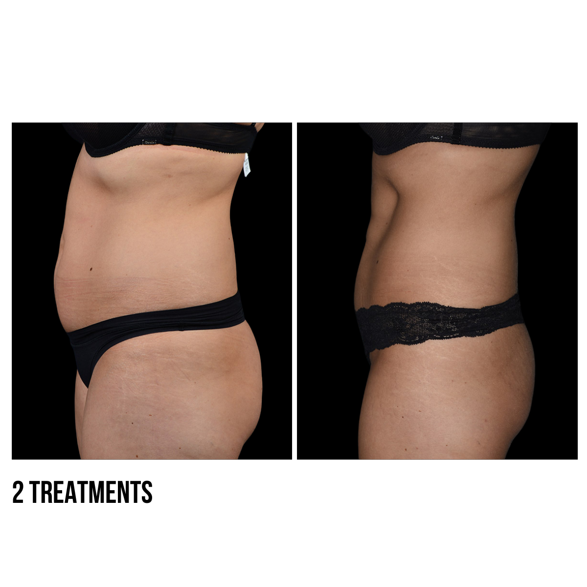 CoolSculpting® Body Contouring – Non-Invasive Fat Reduction