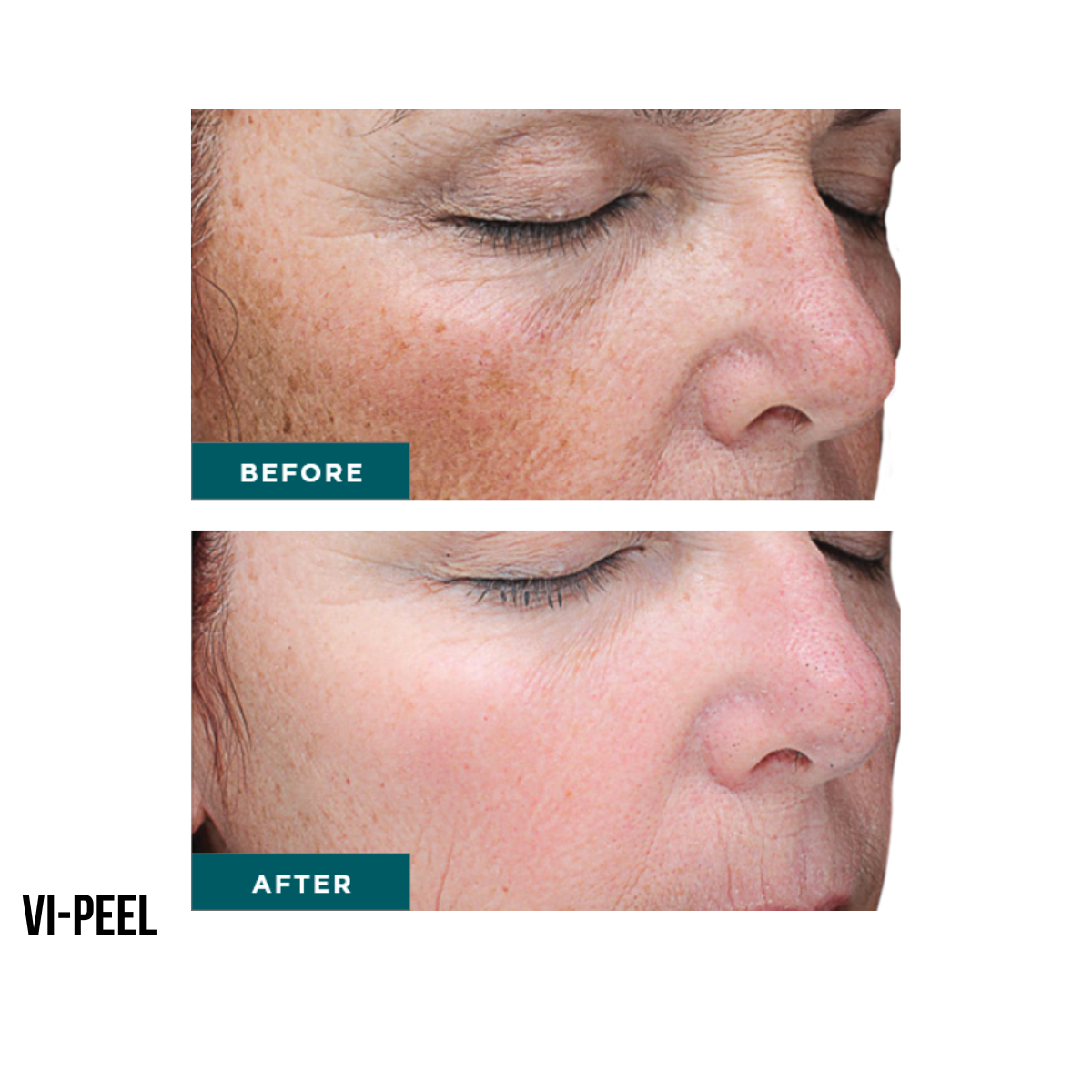 Chemical Peel