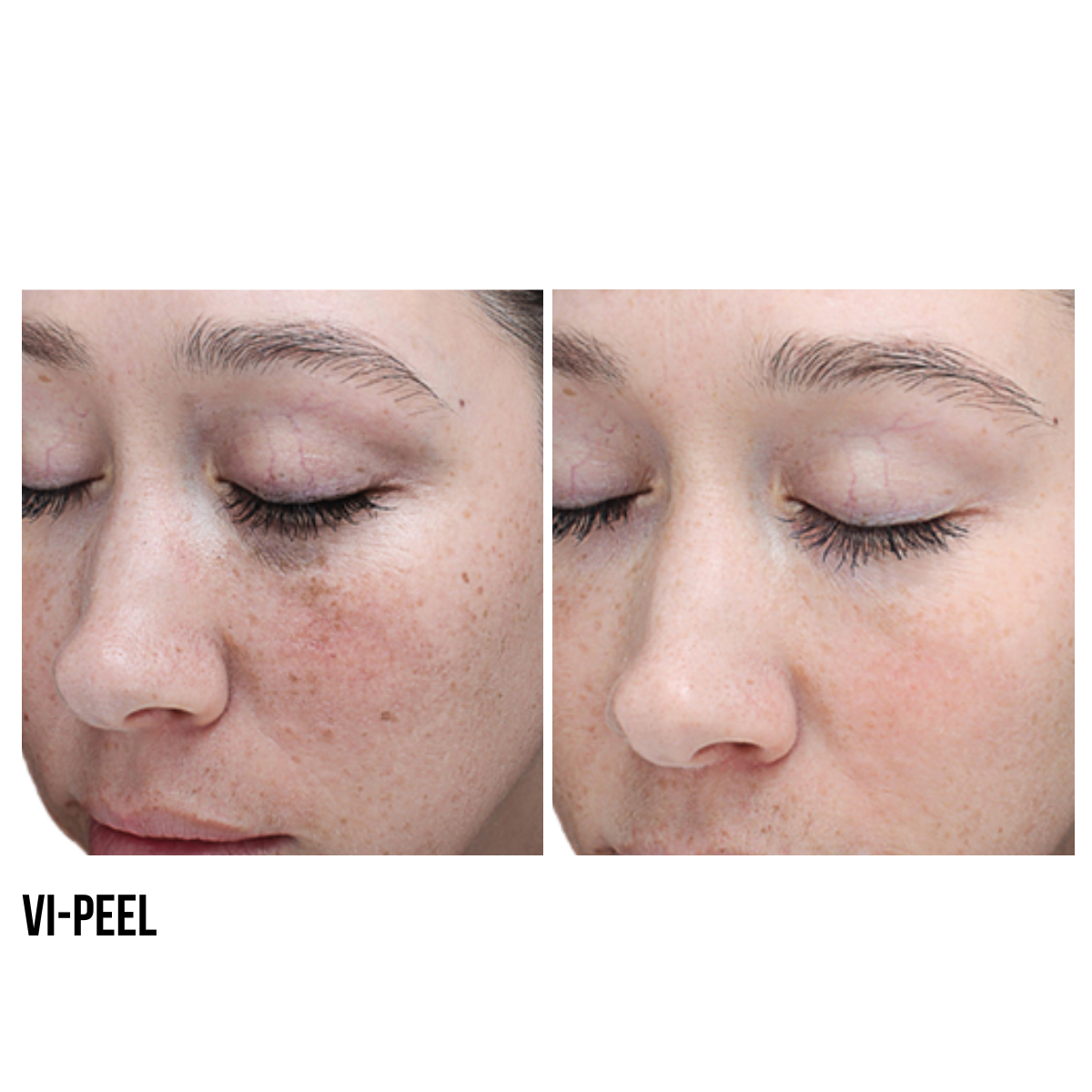 Chemical Peel