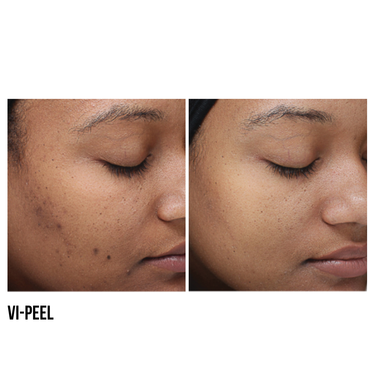 Chemical Peel