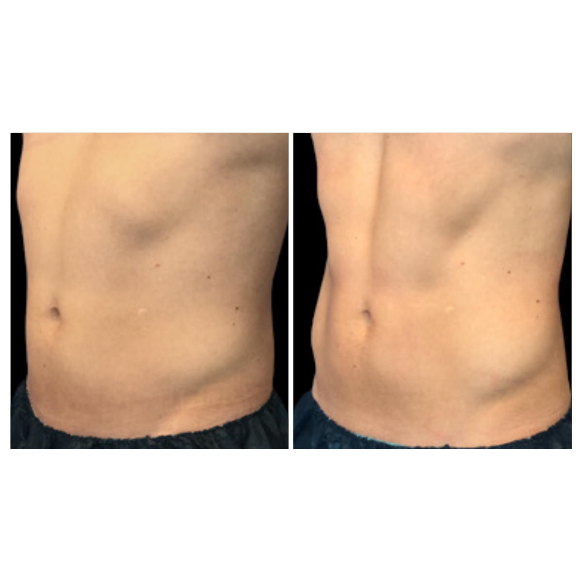 CoolTone® Muscle Toning – Non-Invasive Body Sculpting