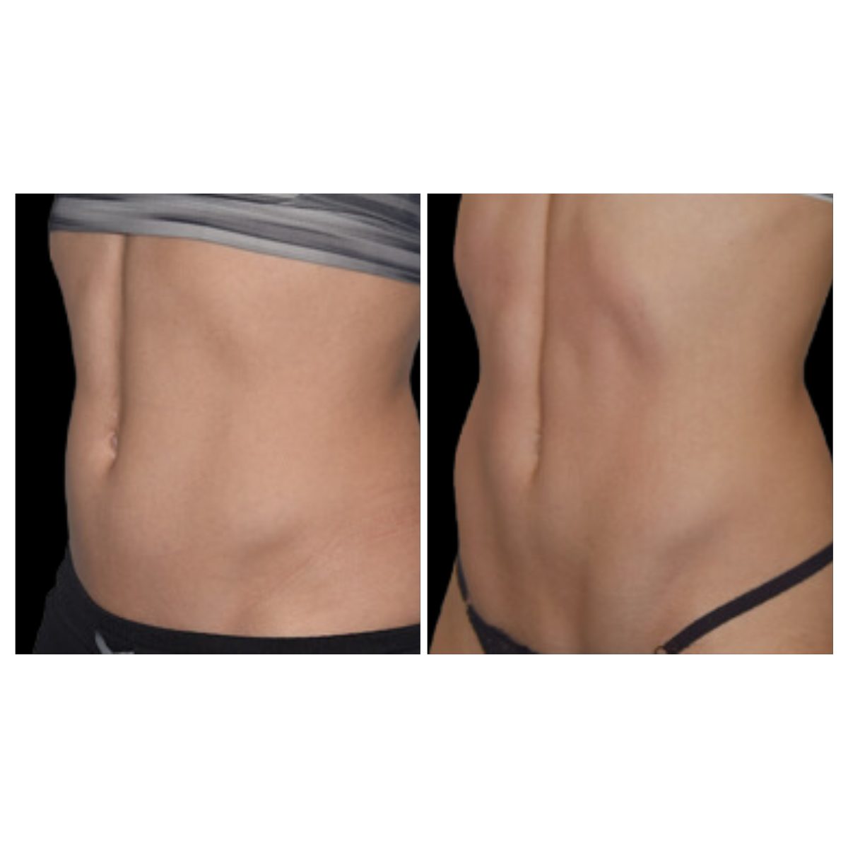 CoolTone® Muscle Toning – Non-Invasive Body Sculpting