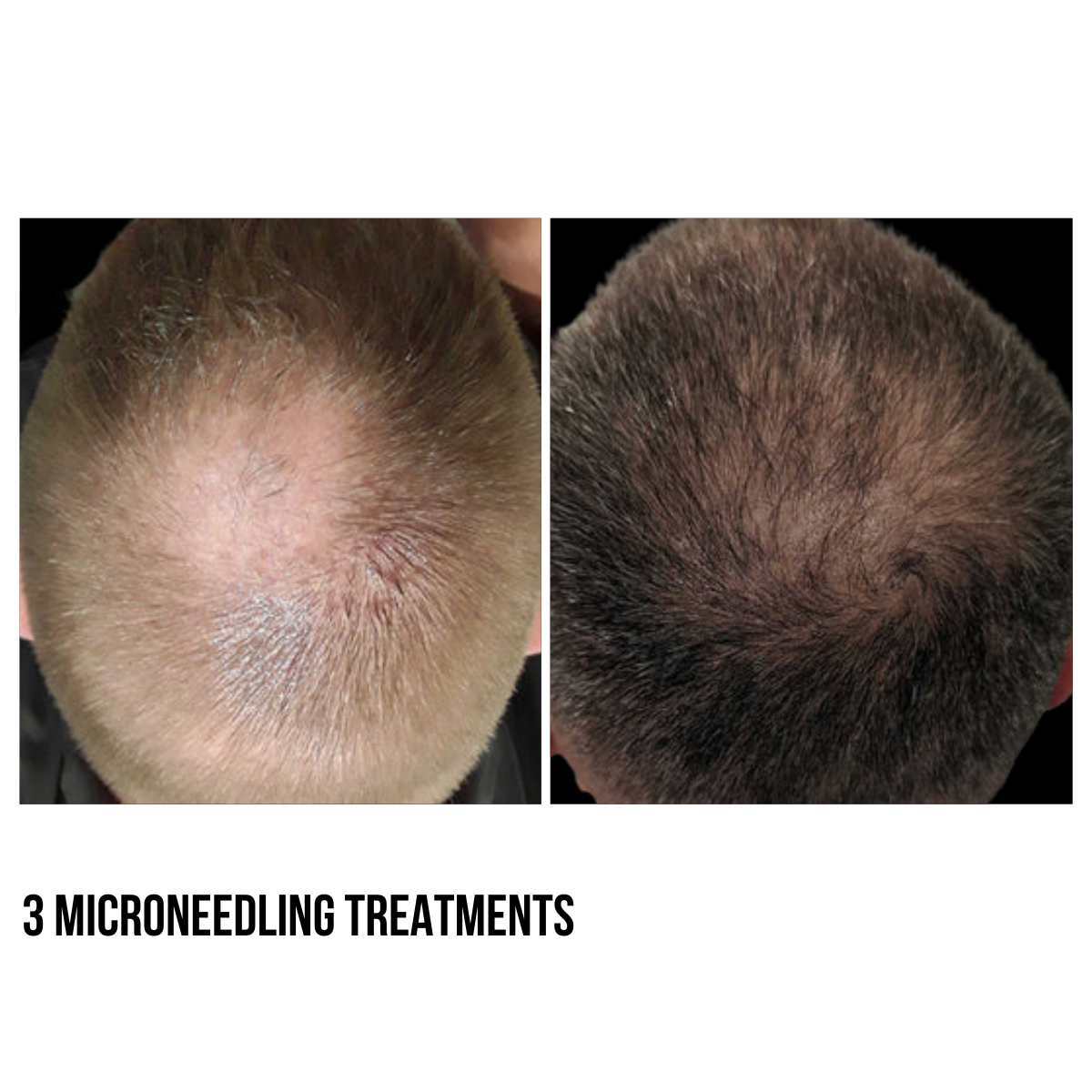 Hair Restoration – PRF Injections & Microneedling with Exosomes