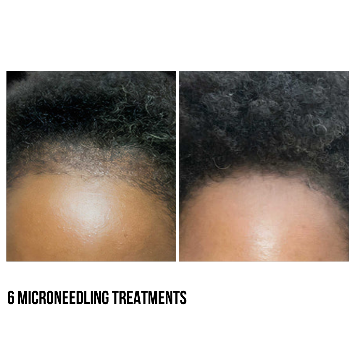 Hair Restoration – PRF Injections & Microneedling with Exosomes