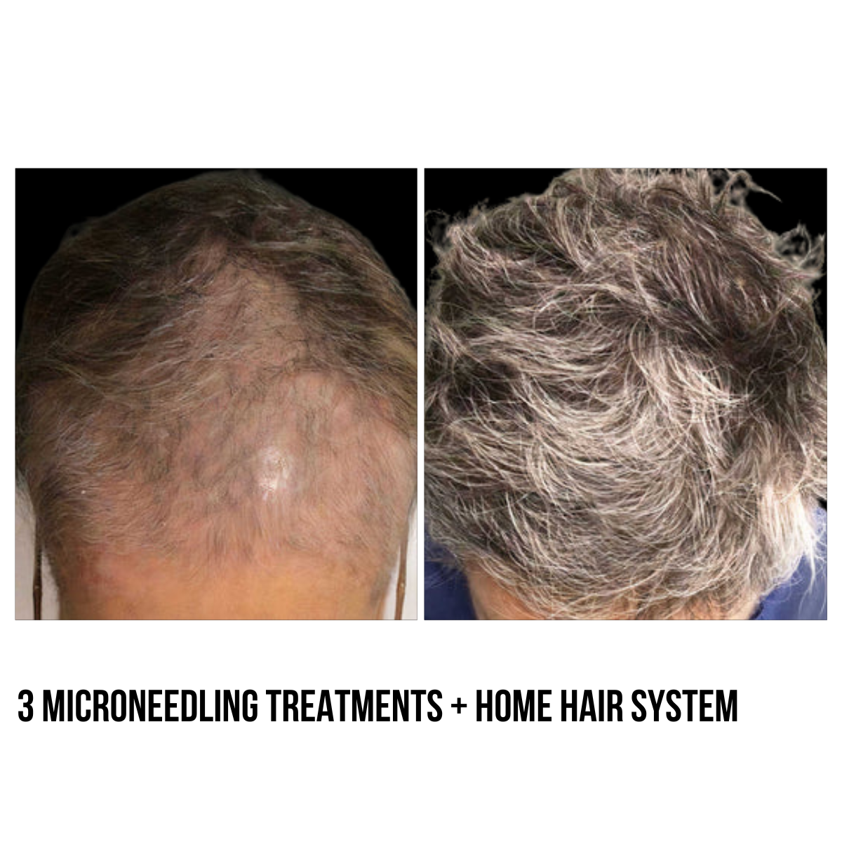 Hair Restoration – PRF Injections & Microneedling with Exosomes