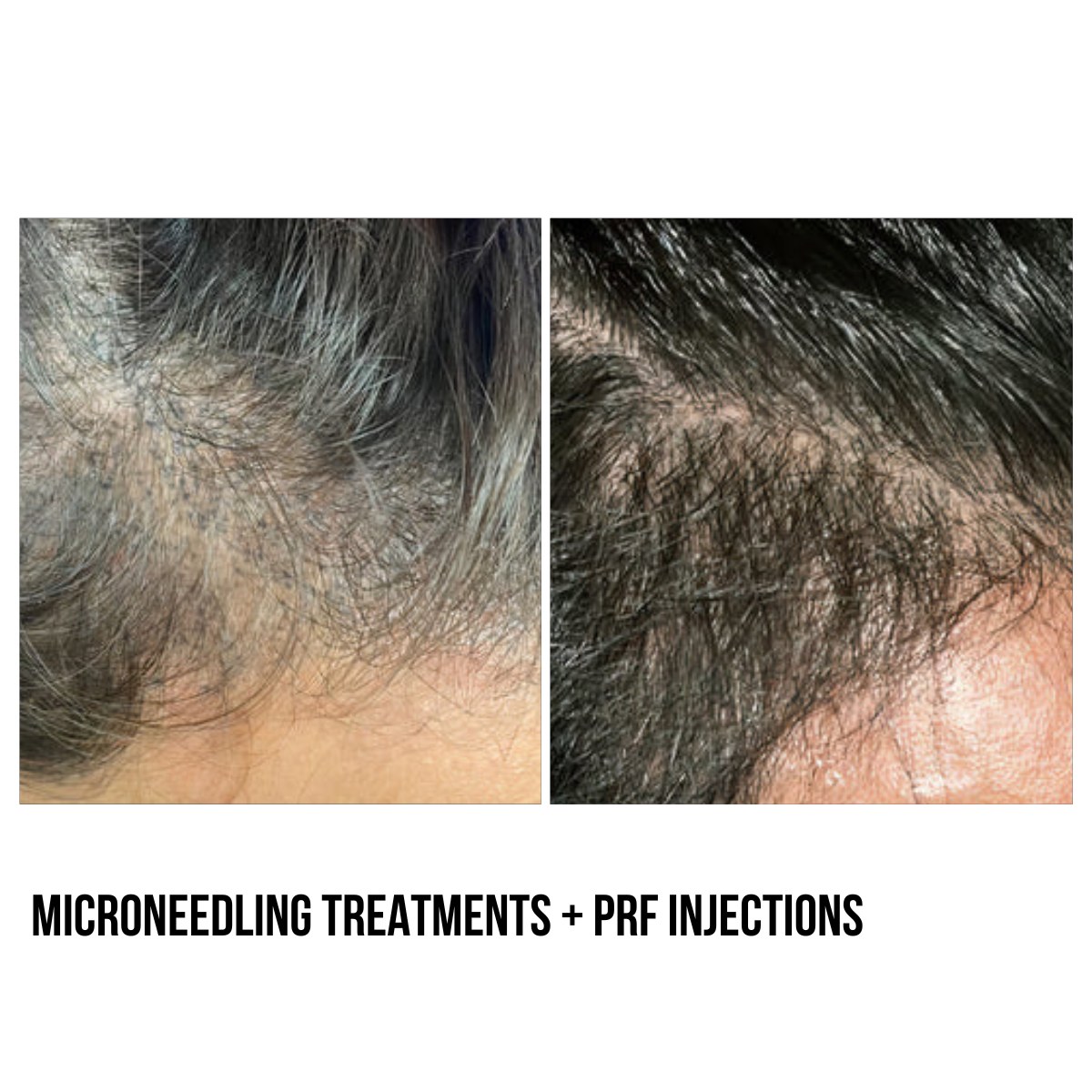 Hair Restoration – PRF Injections & Microneedling with Exosomes