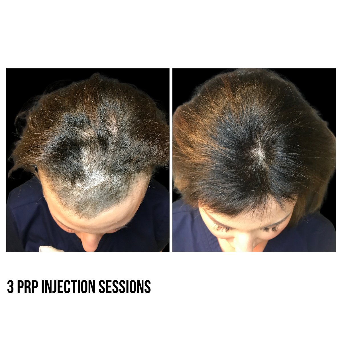 Hair Restoration – PRF Injections & Microneedling with Exosomes