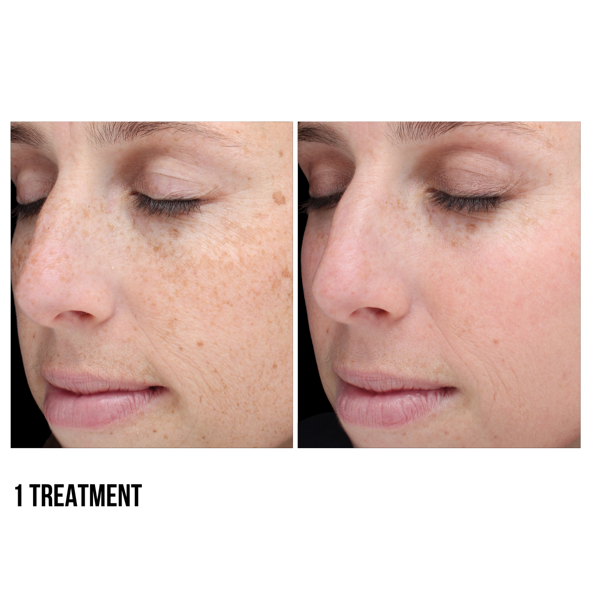 Halo Laser by Sciton – Advanced Skin Resurfacing Treatment