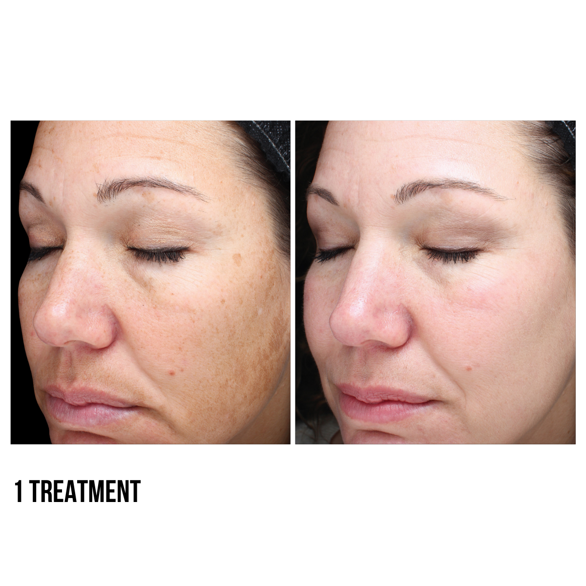 Halo Laser by Sciton – Advanced Skin Resurfacing Treatment