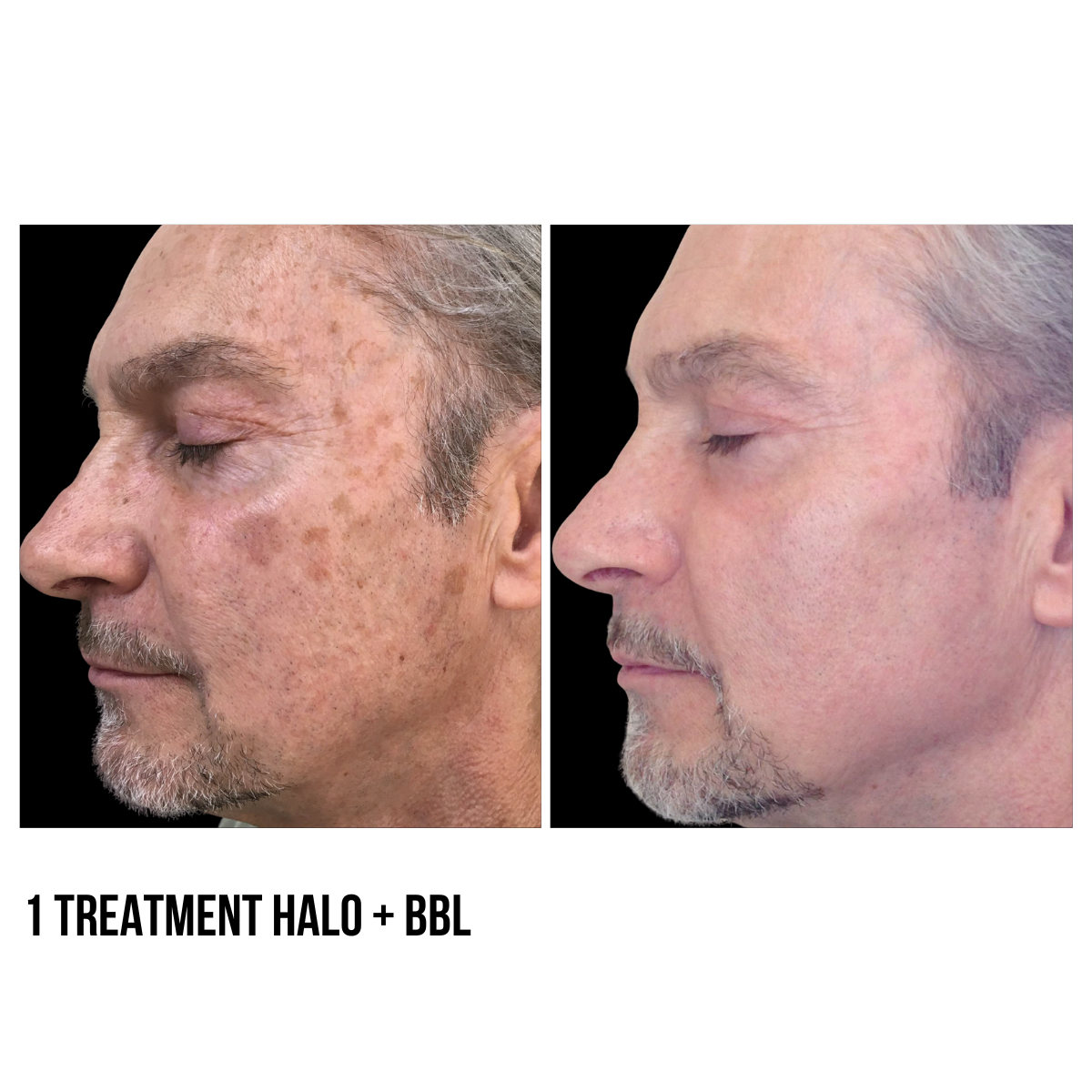 Halo Laser by Sciton – Advanced Skin Resurfacing Treatment