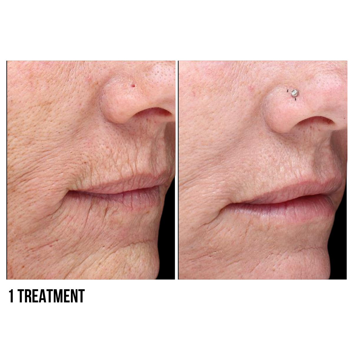 Halo Laser by Sciton – Advanced Skin Resurfacing Treatment