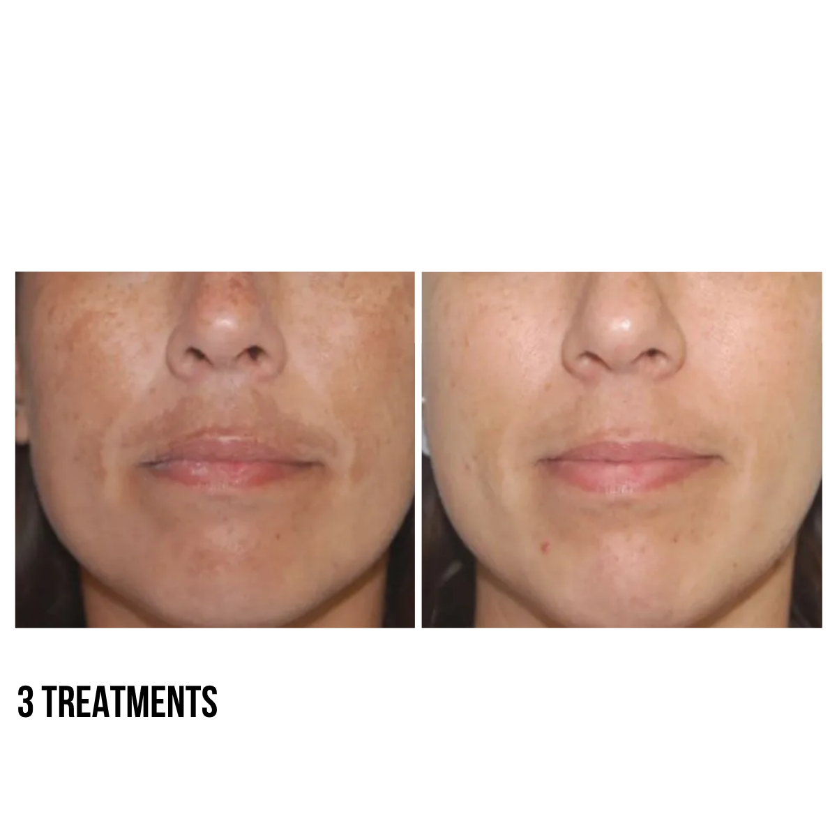 Laser Toning