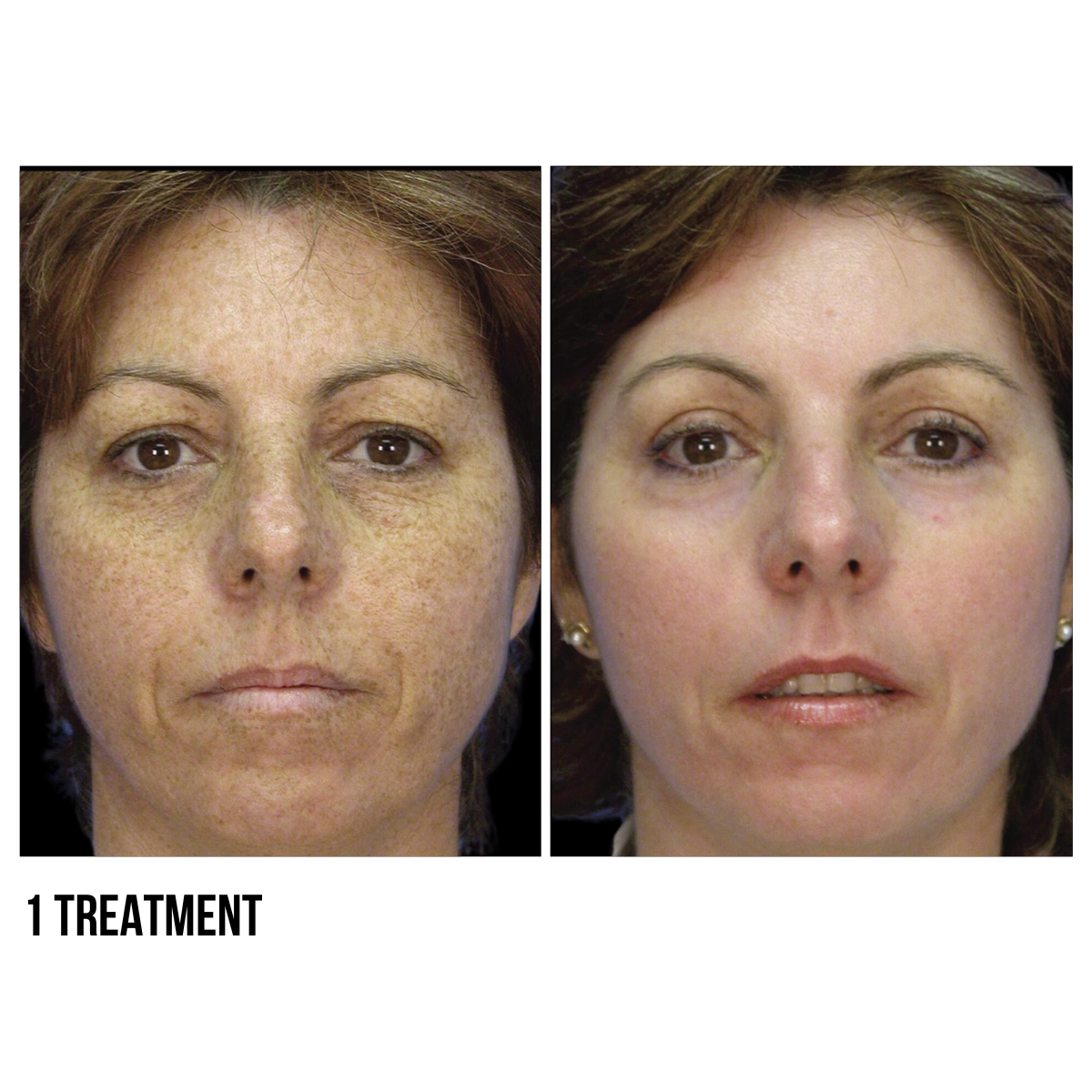 MicroLaserPeel® – Advanced Skin Resurfacing Treatment