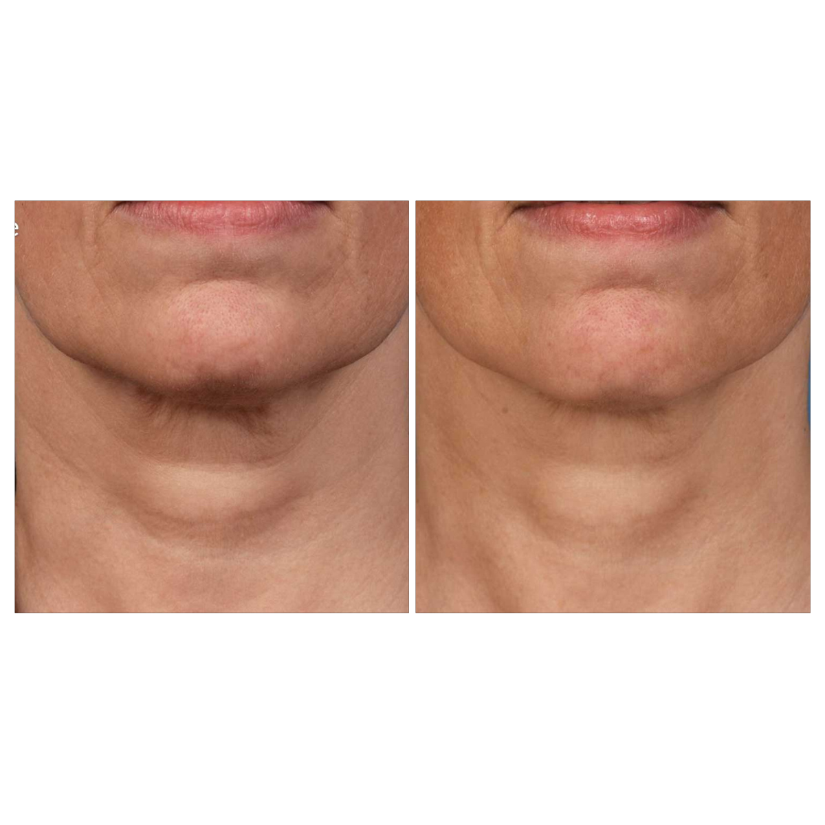 Microneedling - Package of 4