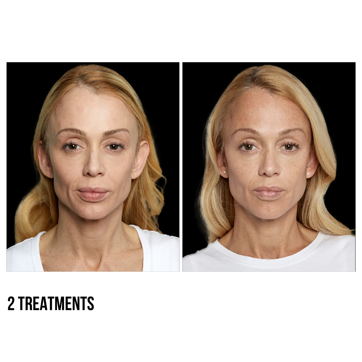 Sculptra® – Stimulate Collagen Production for Long-Lasting Volume and Youthful Skin