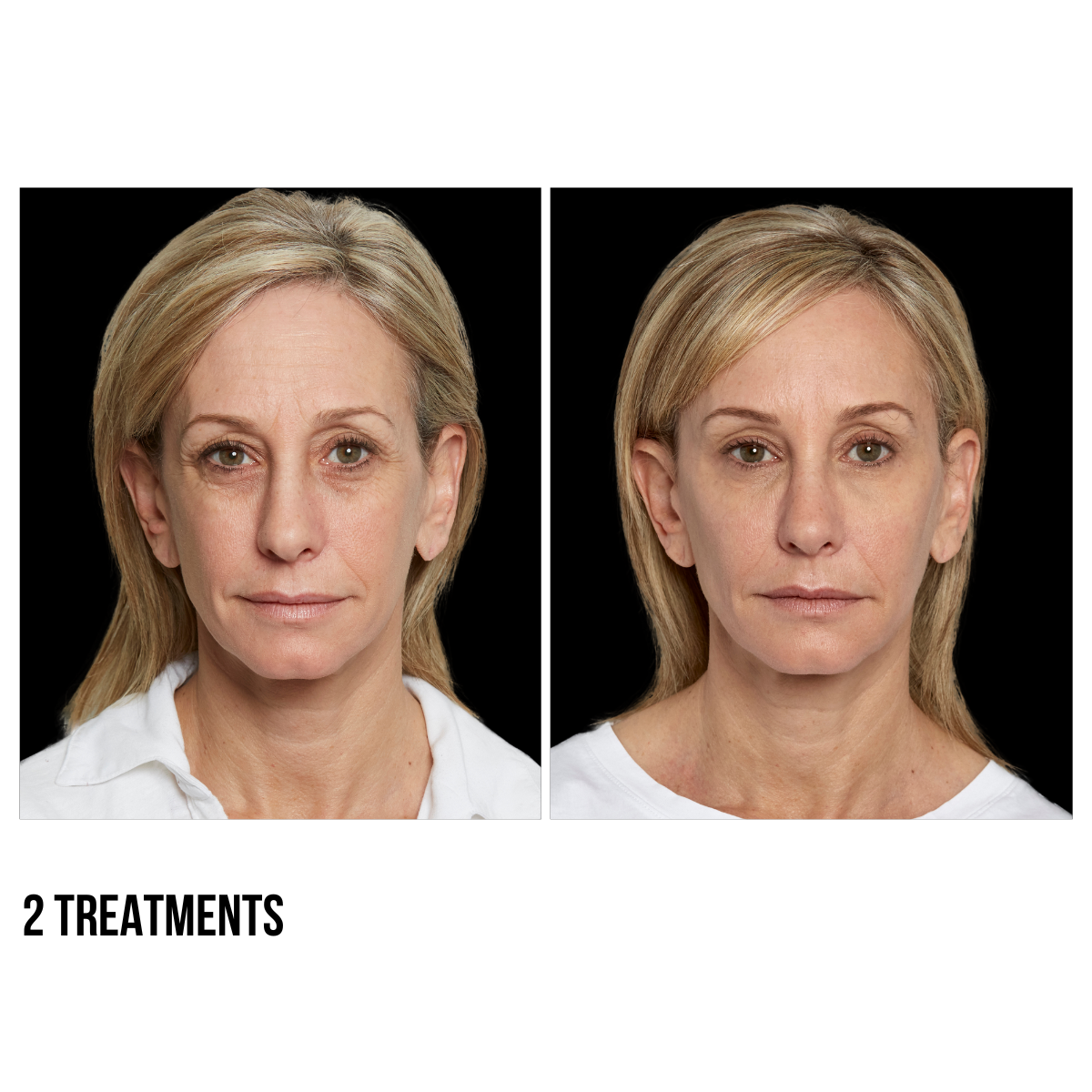 Sculptra® – Stimulate Collagen Production for Long-Lasting Volume and Youthful Skin